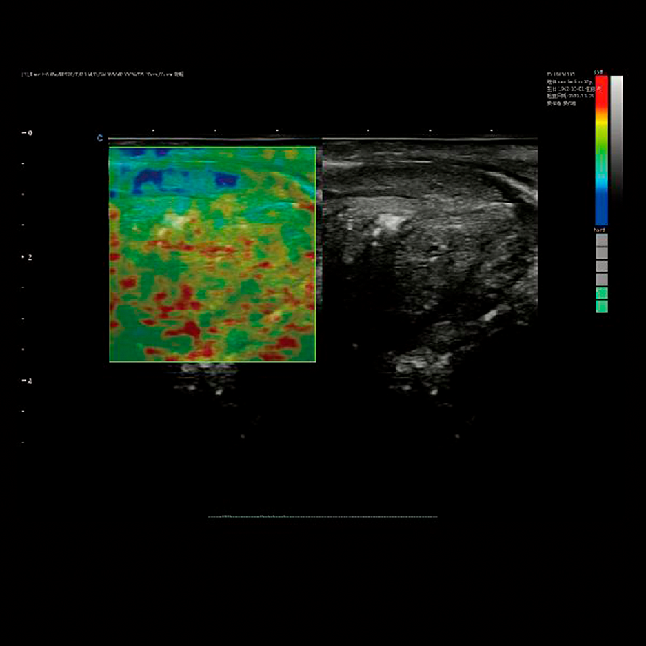 XBit elastografía próstata